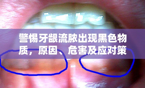 警惕牙齦流膿出現(xiàn)黑色物質(zhì)，原因、危害及應(yīng)對(duì)策略