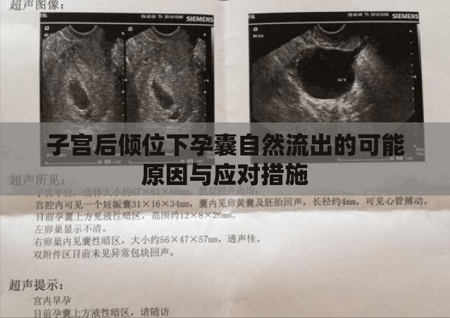 子宮后傾位下孕囊自然流出的可能原因與應(yīng)對(duì)措施