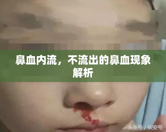 鼻血內(nèi)流，不流出的鼻血現(xiàn)象解析
