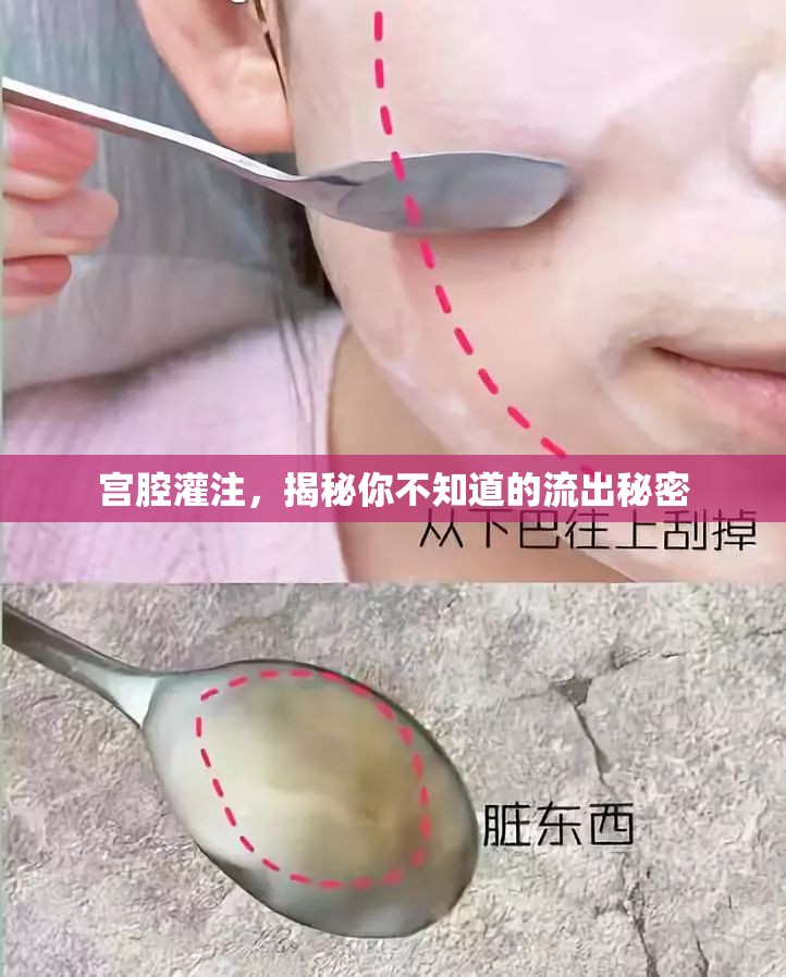 宮腔灌注，揭秘你不知道的流出秘密