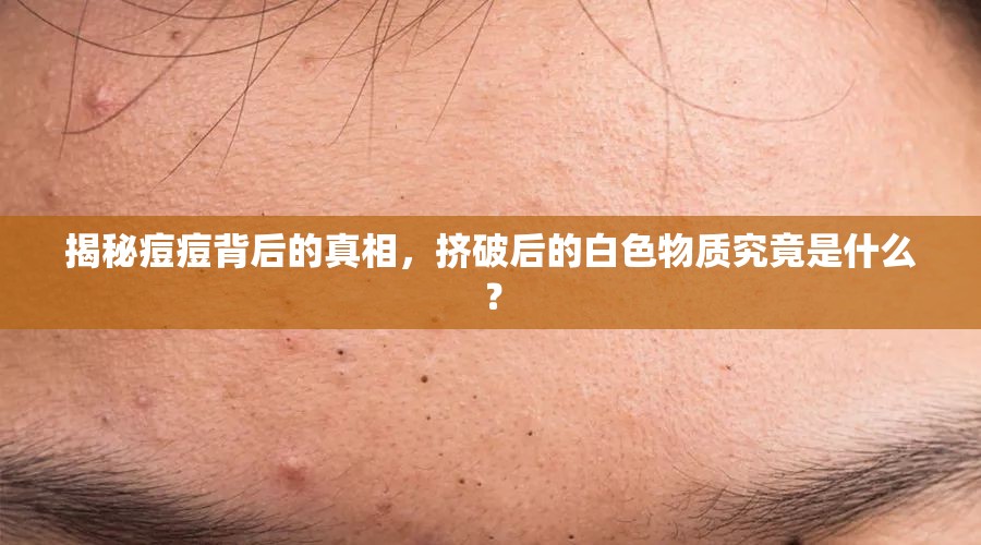 揭秘痘痘背后的真相，擠破后的白色物質(zhì)究竟是什么？