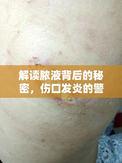 解讀膿液背后的秘密，傷口發(fā)炎的警鐘