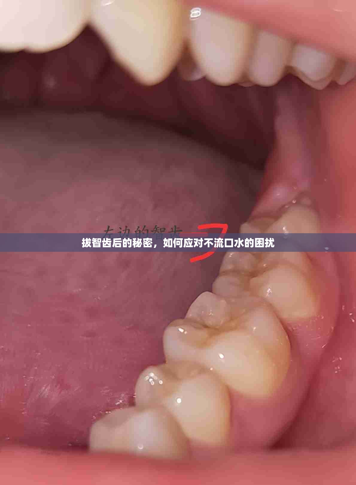 拔智齒后的秘密，如何應(yīng)對不流口水的困擾