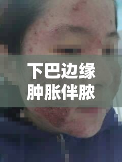 下巴邊緣腫脹伴膿水流出，不容忽視的面部健康警報(bào)