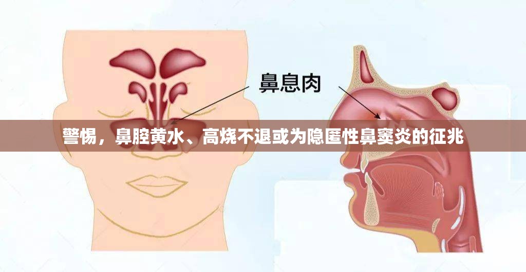 警惕，鼻腔黃水、高燒不退或?yàn)殡[匿性鼻竇炎的征兆