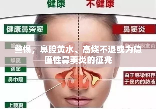 警惕，鼻腔黃水、高燒不退或?yàn)殡[匿性鼻竇炎的征兆