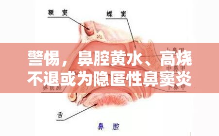 警惕，鼻腔黃水、高燒不退或?yàn)殡[匿性鼻竇炎的征兆