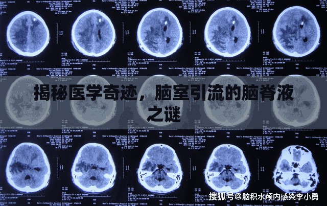 揭秘醫(yī)學(xué)奇跡，腦室引流的腦脊液之謎