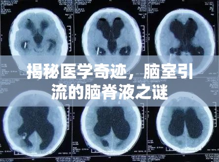 揭秘醫(yī)學(xué)奇跡，腦室引流的腦脊液之謎
