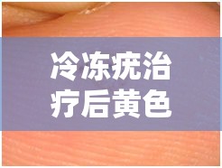 冷凍疣治療后黃色液體真相揭秘，了解那股黃色警報(bào)