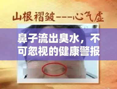 鼻子流出臭水，不可忽視的健康警報(bào)與應(yīng)對(duì)策略