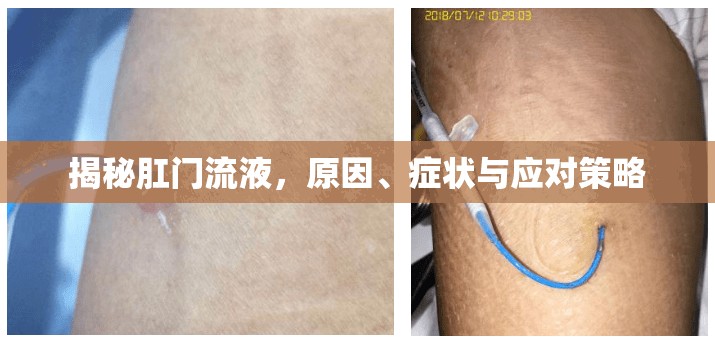 揭秘肛門流液，原因、癥狀與應(yīng)對策略