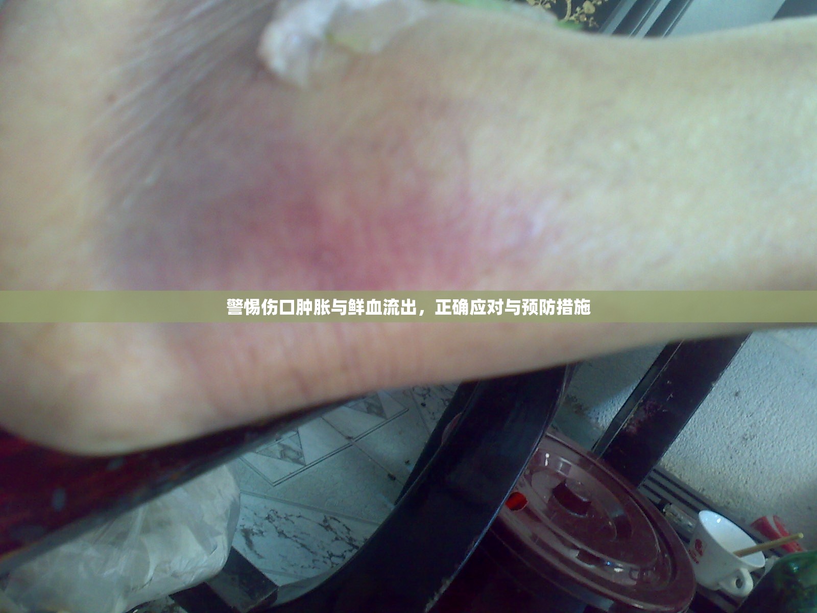 警惕傷口腫脹與鮮血流出，正確應(yīng)對(duì)與預(yù)防措施
