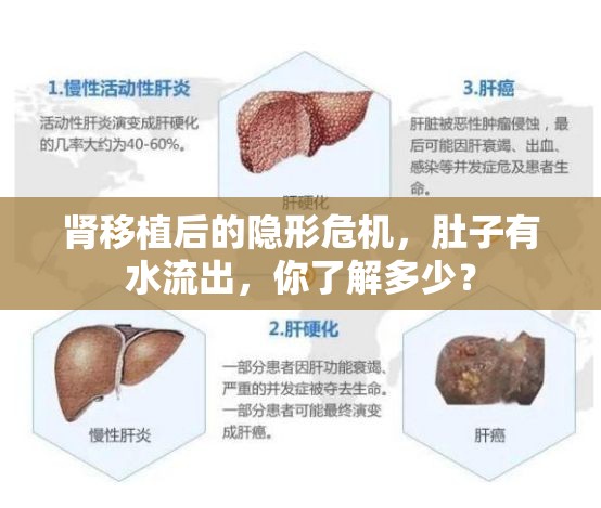腎移植后的隱形危機(jī)，肚子有水流出，你了解多少？