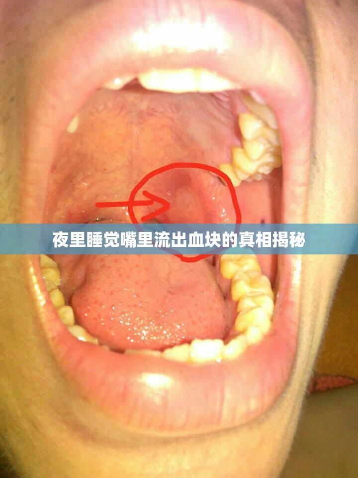 夜里睡覺嘴里流出血塊的真相揭秘