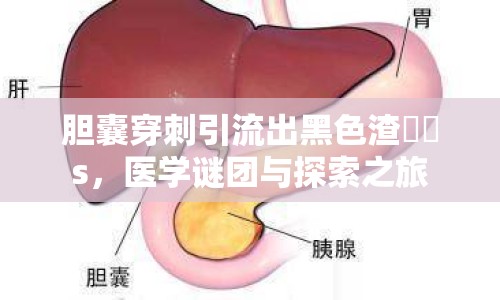 膽囊穿刺引流出黑色渣??s，醫(yī)學謎團與探索之旅