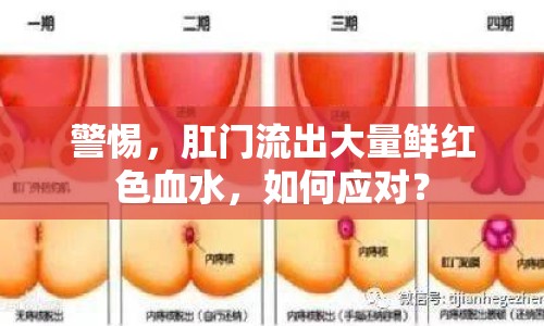 警惕，肛門(mén)流出大量鮮紅色血水，如何應(yīng)對(duì)？