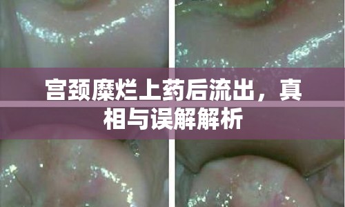 宮頸糜爛上藥后流出，真相與誤解解析