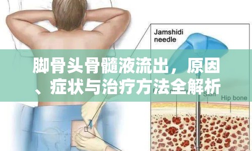 腳骨頭骨髓液流出，原因、癥狀與治療方法全解析
