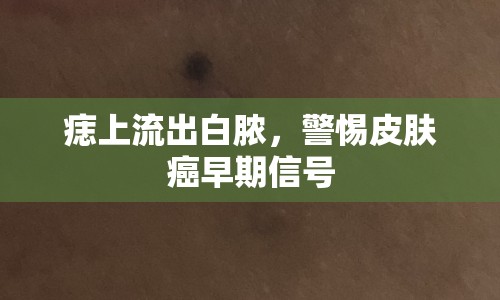 痣上流出白膿，警惕皮膚癌早期信號(hào)
