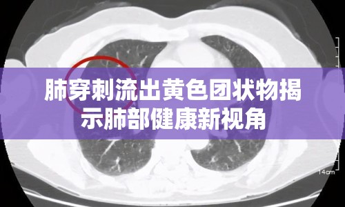肺穿刺流出黃色團(tuán)狀物揭示肺部健康新視角