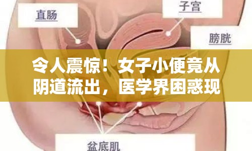 令人震驚！女子小便竟從陰道流出，醫(yī)學(xué)界困惑現(xiàn)象揭秘