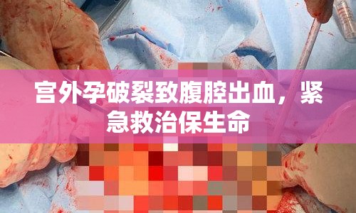 宮外孕破裂致腹腔出血，緊急救治保生命