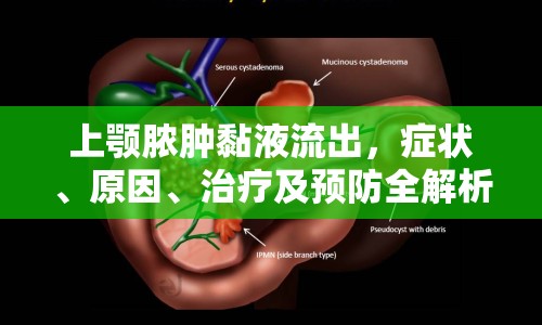 上顎膿腫黏液流出，癥狀、原因、治療及預防全解析