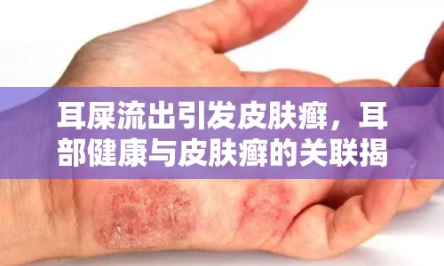 耳屎流出引發(fā)皮膚癬，耳部健康與皮膚癬的關(guān)聯(lián)揭秘