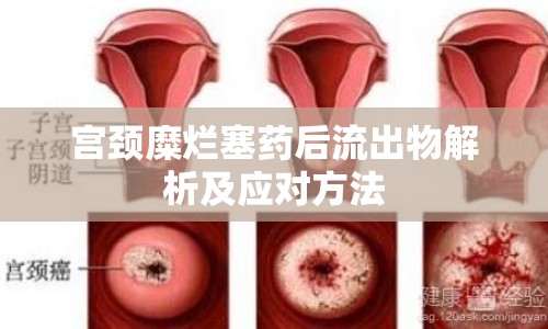 宮頸糜爛塞藥后流出物解析及應(yīng)對方法
