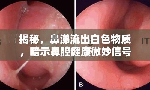 揭秘，鼻涕流出白色物質(zhì)，暗示鼻腔健康微妙信號