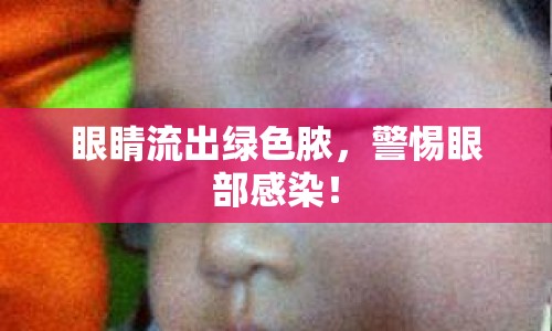 眼睛流出綠色膿，警惕眼部感染！