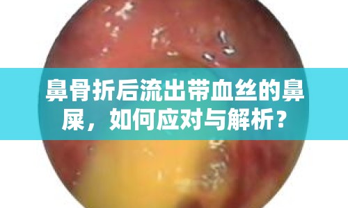 鼻骨折后流出帶血絲的鼻屎，如何應(yīng)對與解析？