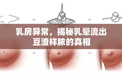 乳房異常，揭秘乳暈流出豆渣樣膿的真相