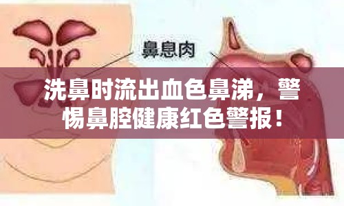 洗鼻時流出血色鼻涕，警惕鼻腔健康紅色警報！