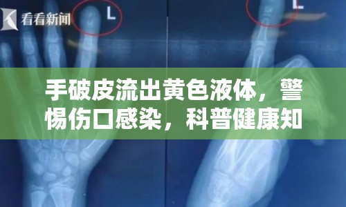 手破皮流出黃色液體，警惕傷口感染，科普健康知識(shí)