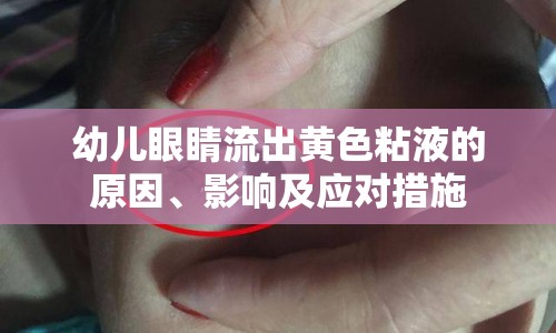 幼兒眼睛流出黃色粘液的原因、影響及應(yīng)對措施