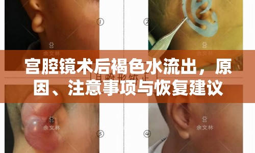 宮腔鏡術(shù)后褐色水流出，原因、注意事項(xiàng)與恢復(fù)建議全解析