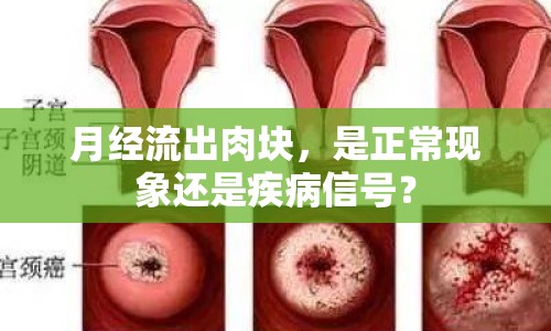 月經(jīng)流出肉塊，是正?，F(xiàn)象還是疾病信號？