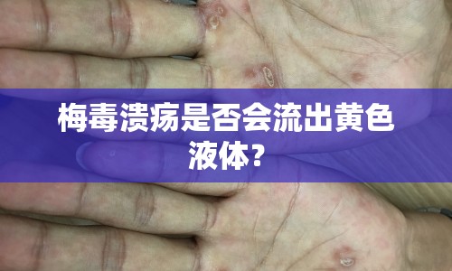 梅毒潰瘍是否會(huì)流出黃色液體？