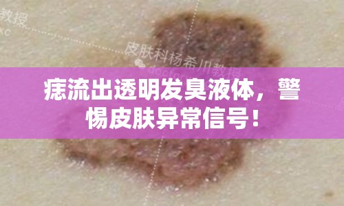 痣流出透明發(fā)臭液體，警惕皮膚異常信號(hào)！