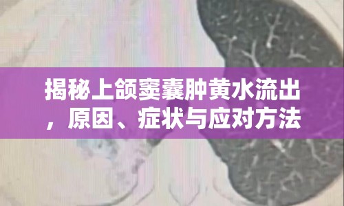 揭秘上頜竇囊腫黃水流出，原因、癥狀與應對方法