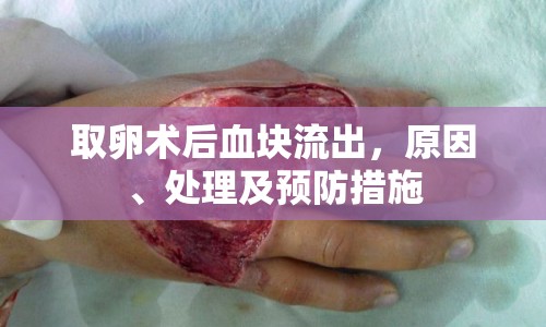 取卵術(shù)后血塊流出，原因、處理及預(yù)防措施