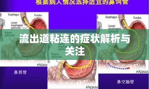 流出道粘連的癥狀解析與關(guān)注