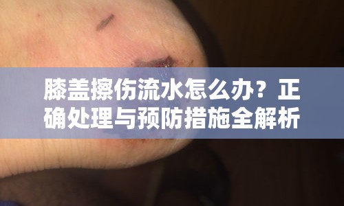 膝蓋擦傷流水怎么辦？正確處理與預(yù)防措施全解析