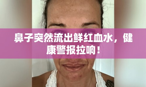 鼻子突然流出鮮紅血水，健康警報(bào)拉響！