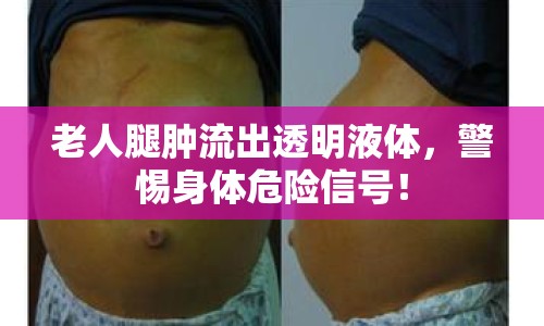 老人腿腫流出透明液體，警惕身體危險信號！