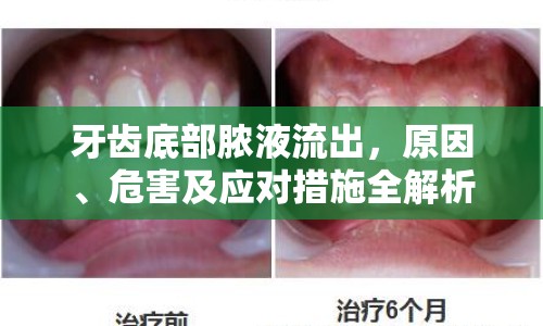 牙齒底部膿液流出，原因、危害及應(yīng)對措施全解析