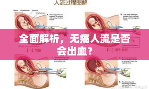 全面解析，無痛人流是否會出血？