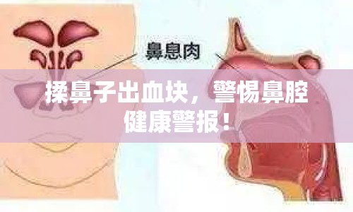 揉鼻子出血塊，警惕鼻腔健康警報！